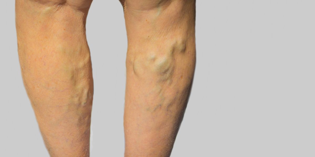 Problemas de circulación venosa en verano-varices