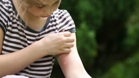 Picaduras de mosquitos en verano