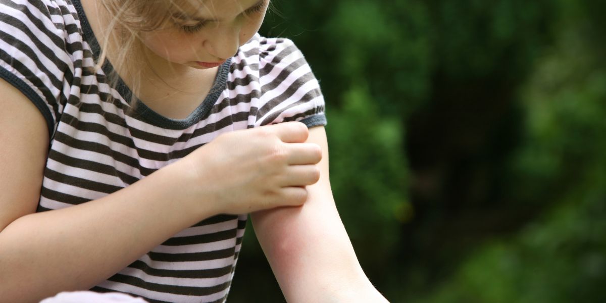 Picaduras de mosquitos en verano
