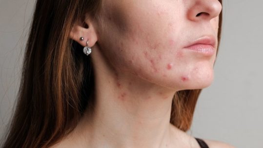 Acne tras verano